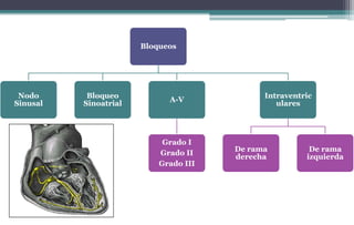 Bloqueos
Nodo
Sinusal
Bloqueo
Sinoatrial
A-V
Grado I
Grado II
Grado III
Intraventric
ulares
De rama
derecha
De rama
izquierda
 