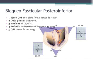Bloqueo Fascicular Posteroinferior
• 1. Eje del QRS en el plano frontal mayor de + 120°.
• 2. Onda q en DII, DIII y aVF.
• 3. Patrón rS en DI y aVL.
• 4. Deflexión intrinsecoide aVF mayor a 45 mseg.
• 5. QRS menor de 120 mseg.
 