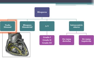 Bloqueos
Nodo
Sinusal
Bloqueo
Sinoatrial
A-V
Grado I
Grado II
Grado III
Intraventric
ulares
De rama
derecha
De rama
izquierda
 