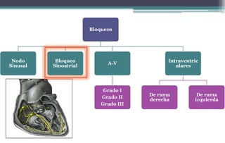 Bloqueos
Nodo
Sinusal
Bloqueo
Sinoatrial
A-V
Grado I
Grado II
Grado III
Intraventric
ulares
De rama
derecha
De rama
izquierda
 