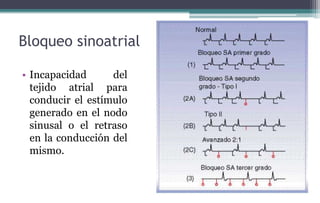 Bloqueo sinoatrial
• Incapacidad del
tejido atrial para
conducir el estímulo
generado en el nodo
sinusal o el retraso
en la conducción del
mismo.
 