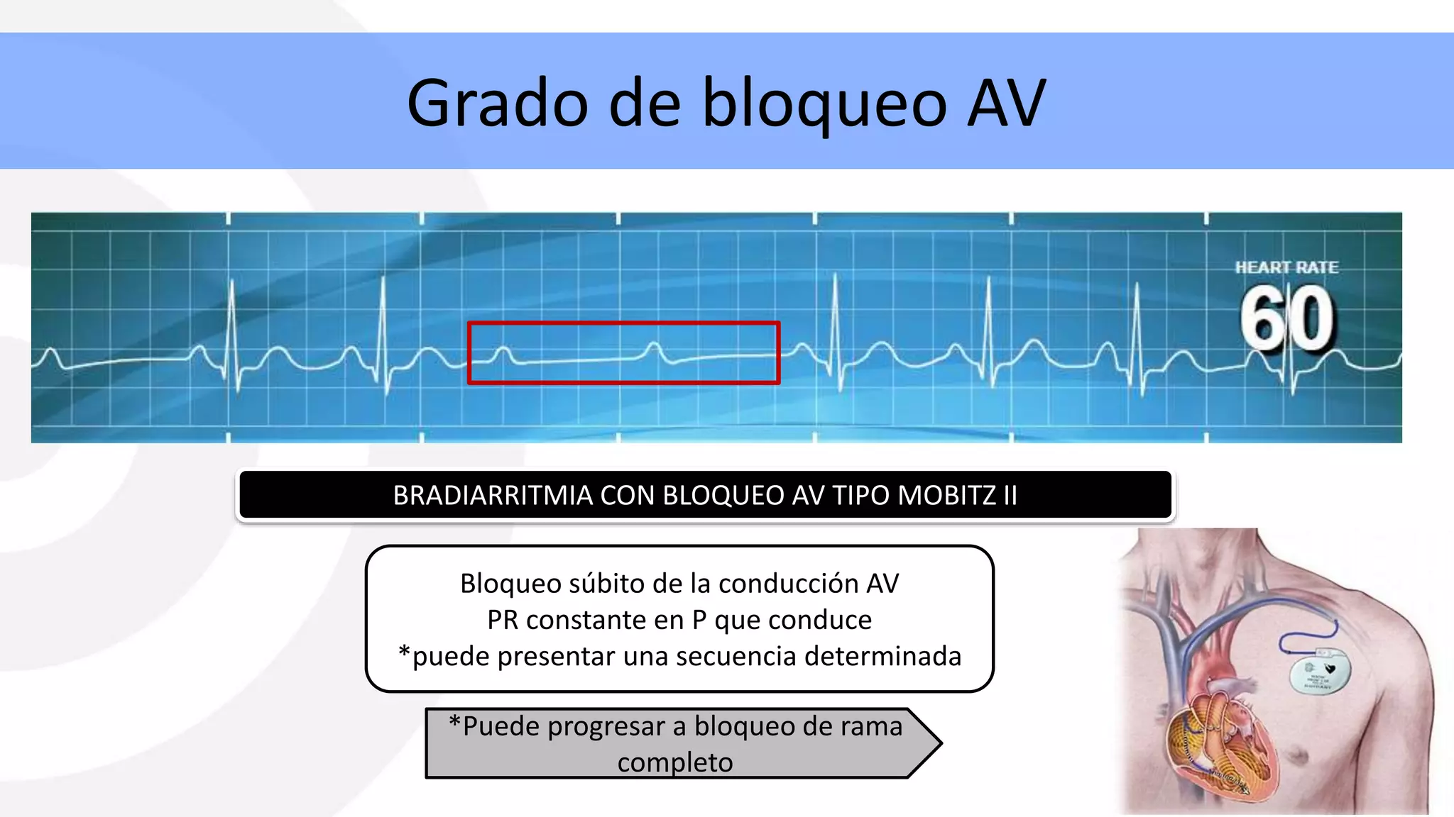 Bloqueos Auriculoventriculares Bloqueos AV PPT