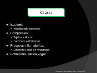  Isquemia.
 Insuficiencia coronaria.
 Compresión.
 Tejido cicatricial.
 Porciones calcificadas.
 Procesos inflamatorios.
 Diferentes tipos de miocarditis.
 Sobreestimulacion vagal.
Causas
Guyton y Hall. Tratado de fisiología médica. 12a edición, 2011.
 