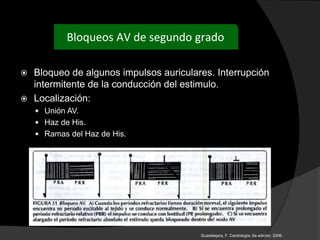  Bloqueo de algunos impulsos auriculares. Interrupción
intermitente de la conducción del estimulo.
 Localización:
 Unión AV.
 Haz de His.
 Ramas del Haz de His.
Bloqueos AV de segundo grado
Guadalajara, F. Cardiología. 6a edición, 2006.
 