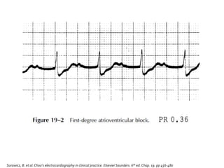 Surawicz, B. et al.Chou’s electrocardiography in clinical practice. Elsevier Saunders. 6th ed. Chap. 19. pp 456-480
 