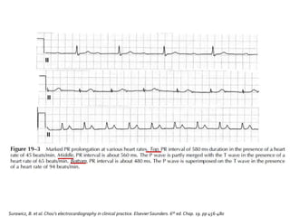 Surawicz, B. et al.Chou’s electrocardiography in clinical practice. Elsevier Saunders. 6th ed. Chap. 19. pp 456-480
 