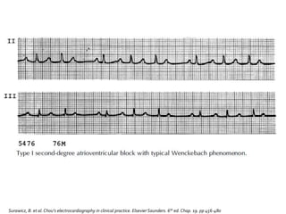 Surawicz, B. et al.Chou’s electrocardiography in clinical practice. Elsevier Saunders. 6th ed. Chap. 19. pp 456-480
 