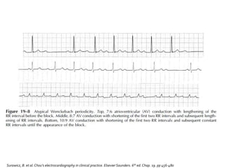 Surawicz, B. et al.Chou’s electrocardiography in clinical practice. Elsevier Saunders. 6th ed. Chap. 19. pp 456-480
 