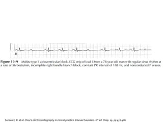 Surawicz, B. et al.Chou’s electrocardiography in clinical practice. Elsevier Saunders. 6th ed. Chap. 19. pp 456-480
 
