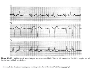 Surawicz, B. et al.Chou’s electrocardiography in clinical practice. Elsevier Saunders. 6th ed. Chap. 19. pp 456-480
 