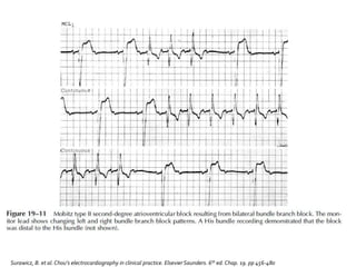 Surawicz, B. et al.Chou’s electrocardiography in clinical practice. Elsevier Saunders. 6th ed. Chap. 19. pp 456-480
 