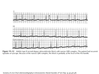 Surawicz, B. et al.Chou’s electrocardiography in clinical practice. Elsevier Saunders. 6th ed. Chap. 19. pp 456-480
 