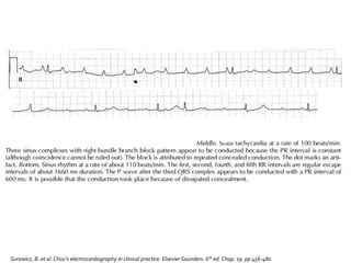Surawicz, B. et al.Chou’s electrocardiography in clinical practice. Elsevier Saunders. 6th ed. Chap. 19. pp 456-480
 