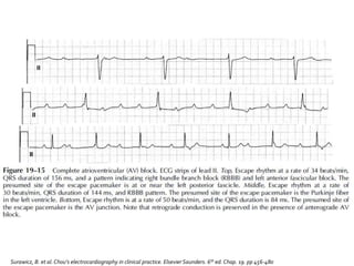 Surawicz, B. et al.Chou’s electrocardiography in clinical practice. Elsevier Saunders. 6th ed. Chap. 19. pp 456-480
 
