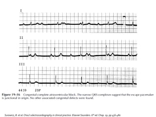 Surawicz, B. et al.Chou’s electrocardiography in clinical practice. Elsevier Saunders. 6th ed. Chap. 19. pp 456-480
 