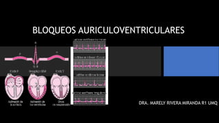 BLOQUEOS AURICULOVENTRICULARES
DRA. MARELY RIVERA MIRANDA R1 UMQ
 