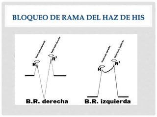 BLOQUEO DE RAMA DEL HAZ DE HIS
 