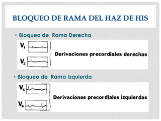 BLOQUEO DE RAMA DEL HAZ DE HIS
• Bloqueo de Rama Derecha
• Bloqueo de Rama Izquierda
 
