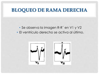 BLOQUEO DE RAMA DERECHA
• Se observa la imagen R-R´ en V1 y V2
• El ventrículo derecho se activa al último.
 
