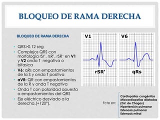 BLOQUEO DE RAMA DERECHA
• QRS>0.12 seg
• Complejos QRS con
morfologia rSr’, rsR’, rSR‘ en V1
y V2 onda T negativa o
bifasica
• V6: qRs con empastamientos
de la S y onda T positiva
• aVR: QR con empastamientos
de la R y onda T negativa
• Onda T con polaridad opuesta
a empastamientos del QRS
• Eje eléctrico desviado a la
derecha.(+120°).
Cardiopatías congénitas
Miocardiopatías dilatadas
(Enf. de Chagas)
Hipertensión pulmonar
Estenosis pulmonar
Estenosis mitral
Fcte en:
BLOQUEO DE RAMA DERECHA
 