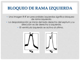 BLOQUEO DE RAMA IZQUIERDA
• Una imagen R-R´en precordiales izquierdas significa bloqueo
de rama izquierda.
• La despolarización se inicia del lado derecho del septum y su
dirección es de derecha a izquierda.
• El ventrículo izquierdo se activa al ultimo.
 