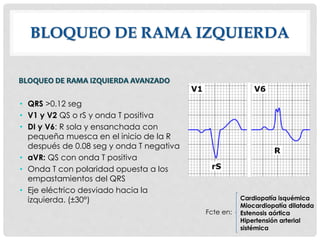 BLOQUEO DE RAMA IZQUIERDA
BLOQUEO DE RAMA IZQUIERDA AVANZADO
• QRS >0.12 seg
• V1 y V2 QS o rS y onda T positiva
• DI y V6: R sola y ensanchada con
pequeña muesca en el inicio de la R
después de 0.08 seg y onda T negativa
• aVR: QS con onda T positiva
• Onda T con polaridad opuesta a los
empastamientos del QRS
• Eje eléctrico desviado hacia la
izquierda. (±30°) Cardiopatía isquémica
Miocardiopatía dilatada
Estenosis aórtica
Hipertensión arterial
sistémica
Fcte en:
 