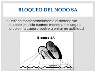 BLOQUEO DEL NODO SA
• Detiene momentáneamente el marcapaso
durante un ciclo cuando menos, pero luego el
propio marcapaso vuelve a entrar en actividad
 