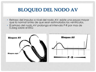 BLOQUEO DEL NODO AV
• Retraso del impulso a nivel del nodo AV; existe una pausa mayor
que la normal antes de que sean estimulados los ventrículos.
• El retraso del nodo AV prolonga el intervalo P-R por mas de
0,2seg sobre el EKG
 