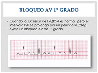 BLOQUEO AV 1º GRADO
• Cuando la sucesión de P-QRS-T es normal, pero el
intervalo P-R se prolonga por un periodo >0,2seg
existe un Bloqueo AV de 1º grado
 