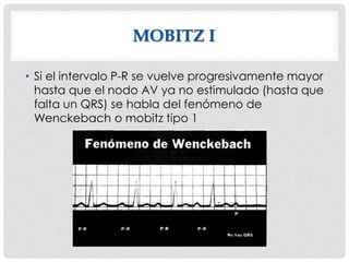 MOBITZ I
• Si el intervalo P-R se vuelve progresivamente mayor
hasta que el nodo AV ya no estimulado (hasta que
falta un QRS) se habla del fenómeno de
Wenckebach o mobitz tipo 1
 