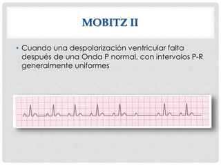 MOBITZ II
• Cuando una despolarización ventricular falta
después de una Onda P normal, con intervalos P-R
generalmente uniformes
 