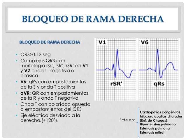 Bloqueos cardiacos