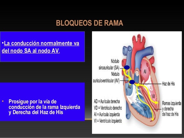 Bloqueos de rama del Haz de His