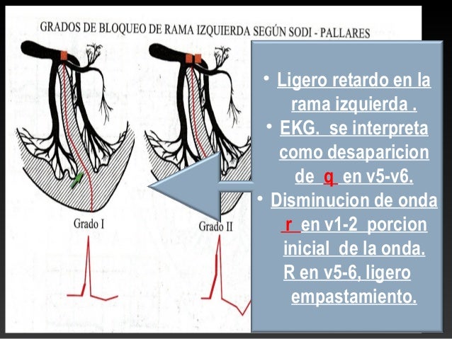 Bloqueos de rama del Haz de His