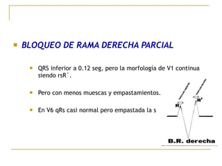  BLOQUEO DE RAMA DERECHA PARCIAL
 QRS inferior a 0.12 seg, pero la morfología de V1 continua
siendo rsR´.
 Pero con menos muescas y empastamientos.
 En V6 qRs casi normal pero empastada la s
 