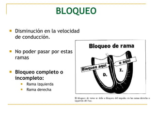 BLOQUEO
 Disminución en la velocidad
de conducción.
 No poder pasar por estas
ramas
 Bloqueo completo o
incompleto:
 Rama izquierda
 Rama derecha
 