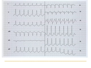 Ritmo sinusal con imagen de bloqueo de rama derecha, con hemibloqueo anterior de rama izquierda. Se
define como bloqueo bifascicular la presencia de bloqueo de dos de las tres ramas de conducción
ventricular
 