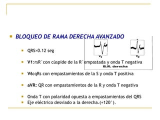  BLOQUEO DE RAMA DERECHA AVANZADO
 QRS>0.12 seg
 V1:rsR´con cúspide de la R´empastada y onda T negativa
 V6:qRs con empastamientos de la S y onda T positiva
 aVR: QR con empastamientos de la R y onda T negativa
 Onda T con polaridad opuesta a empastamientos del QRS
 Eje eléctrico desviado a la derecha.(+120°).
 