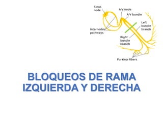 BLOQUEOS DE RAMA
IZQUIERDA Y DERECHA
 