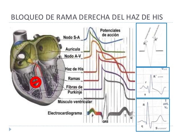 Bloqueos de rama del haz de his