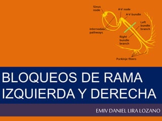 BLOQUEOS DE RAMA 
IZQUIERDA Y DERECHA 
EMIV DANIEL LIRA LOZANO 
 