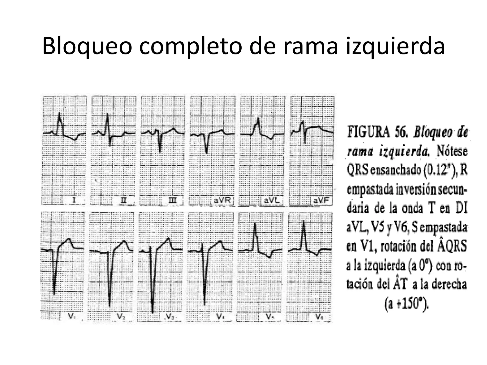Bloqueos de rama y bloqueos fasciculares | PPTX
