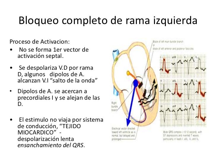 Bloqueos de rama y bloqueos fasciculares Bloqueos de rama y bloqueos fasciculares