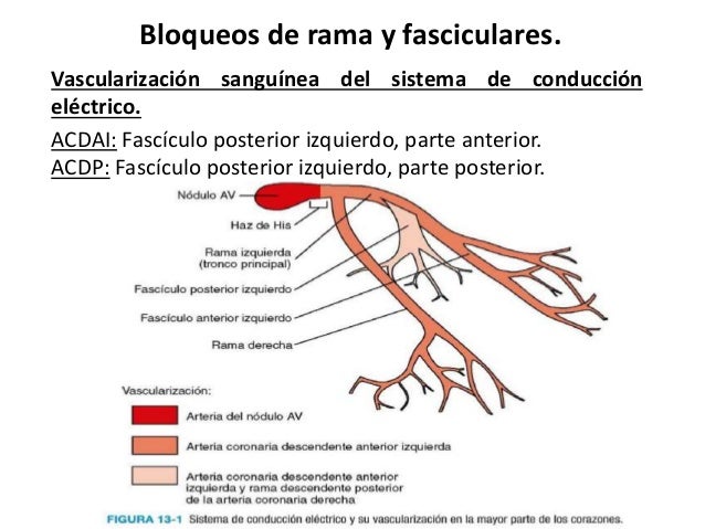 Bloqueos de rama y fasciculares