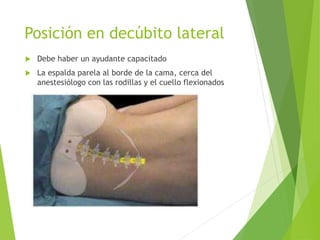 Posición en decúbito lateral 
 Debe haber un ayudante capacitado 
 La espalda parela al borde de la cama, cerca del 
anestesiólogo con las rodillas y el cuello flexionados 
 