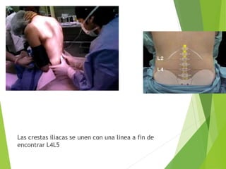 Las crestas iliacas se unen con una linea a fin de 
encontrar L4L5 
 