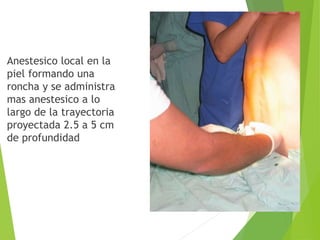 Anestesico local en la 
piel formando una 
roncha y se administra 
mas anestesico a lo 
largo de la trayectoria 
proyectada 2.5 a 5 cm 
de profundidad 
 