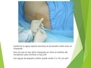 Conforme la aguja espinal atraviesa al duramadre suele oirse un 
chasquido 
Una vez que se oye dicho chasquido se retira el estilete del 
introductor para verificar si hay LCR 
Con agujas de pequeño calibre puede tardar 5 a 10 s en salir 
 