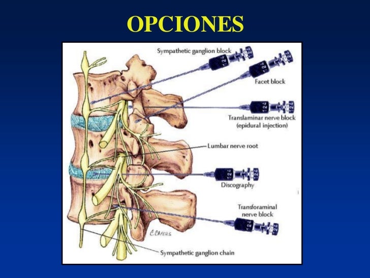 Recuperación Después De Un Bloqueo Lumbar Principios, metodología e indicaciones del bloqueo epidural en el tra…
