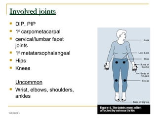 Involved joints
   DIP, PIP
   1st carpometacarpal
   cervical/lumbar facet
    joints
   1st metatarsophalangeal
   Hips
   Knees

    Uncommon
   Wrist, elbows, shoulders,
    ankles


03/08/13                        20
 